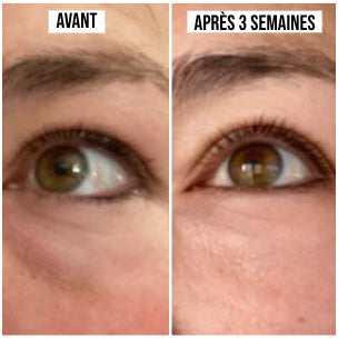 Résultat visible avant et après 3 semaines d'utilisation de la crème anti-cernes IDILI